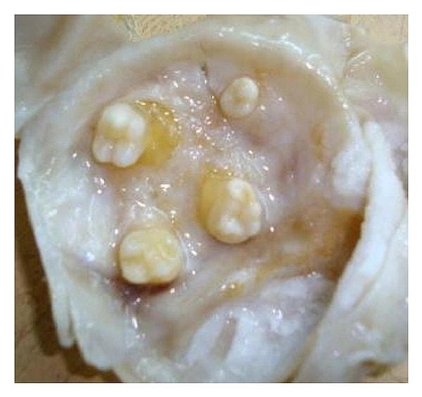 15. "Bir kadının yumurtalıklarında ve bir erkeğin testislerinde dişlerin büyümesine neden olabilen bir tür tümör olması! Aşırı korkunç!"