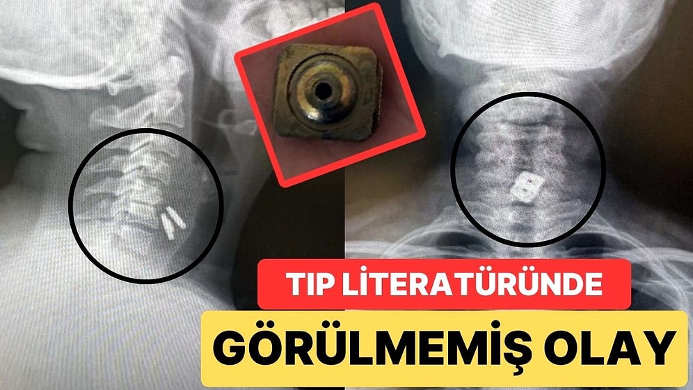 Tıp Literatüründe Görülmemiş Olay! Boynuna Takılan İmplant Yemek Borusunu Yırtıp Midesine Düştü