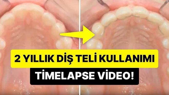 2 Yıllık Diş Teli Kullanımı Sonucunda Dişlerdeki Düzelmeyi Gösteren Etkileyici Timelapse Video