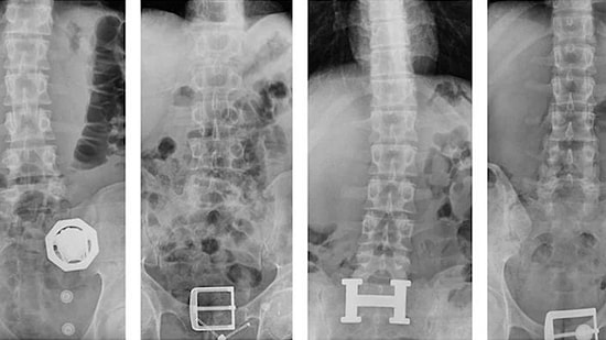 Bu da Oldu: 4 Şüphelinin Midesinden 121 Parça Eroin Çıktı