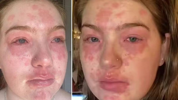 Тем временем, многие пользователи комментируют видео Вирджинии, которая делится своей ситуацией в социальных сетях, предполагая, что ее парень изменял ей и что, возможно, ее тело предупреждает ее таким образом.