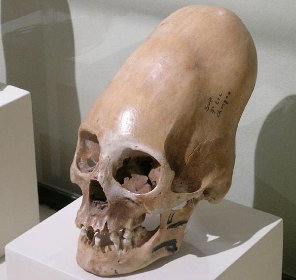 14. Birçok eski kültürde kranial deformasyon sonucu uzun kafalar ortaya çıkıyordu. Bunlardan en ünlüsü de Paracas kültüründen gelenler. Bebeklerin kafatası, iki tahta plaka arasına veya kumaşa bağlanarak bir tür kuvvet uygulandı.