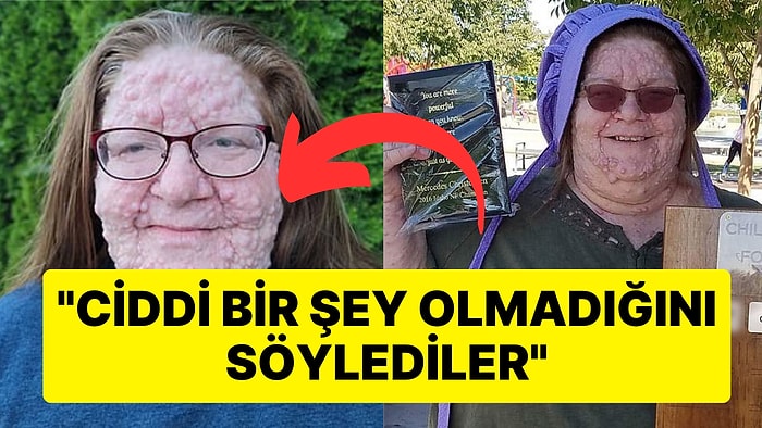 Yüzündeki Tümörün Leke Olduğunu Zanneden Talihsiz Kadının Akıllara Durgunluk Veren Hikayesi