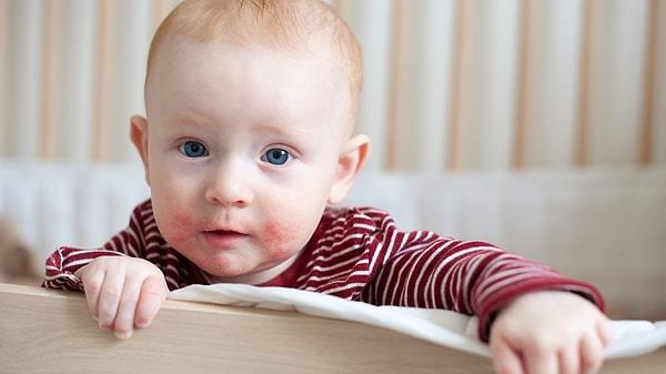 Bebeklerde ıspanak alerjisi belirtileri nedir?
