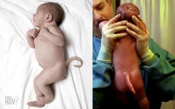 Bir bebeğin kuyruğa benzer bir yapıya sahip olması genellikle zararsızdır ve herhangi bir tıbbi müdahale gerektirmez.