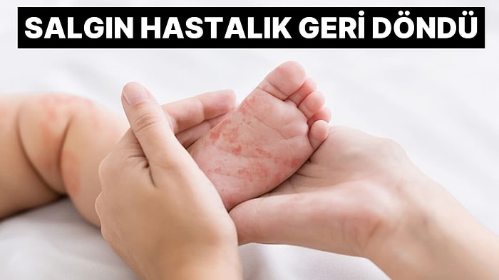 Sağlık Bakanlığı'ndan 81 İle Kızamık Uyarısı: Salgın Hastalık Geri Döndü