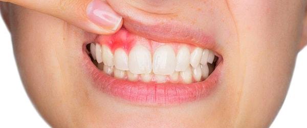 Dişleriniz ile ilgili hastalıklarınız olabilir. Kemikler hassastır.