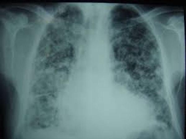 Mezotelyoma, akciğer zarı kanseri olarak bilinen ve yüksek düzeyde öldürücü olarak kayıtlara geçen bir hastalık.