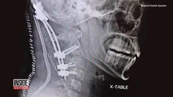 5. Geçirdiği kazadan sonra kafası tekrar dikilen bu çocuğun X-ray görüntüsü.