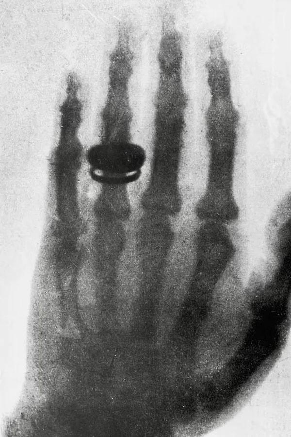 8. Çekilen ilk tıbbi röntgen.