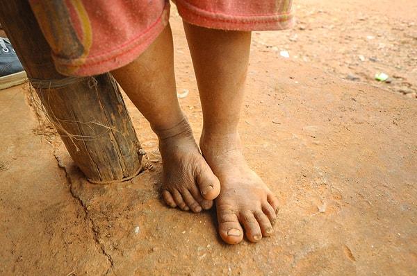 Peki ya sokakta çıplak ayakla gezenler? Fakir ülkelerde halkın sokakta çıplak ayakla gezmesi yoksulluğun göstergesiyken aynı şey refah içerisinde yaşayan toplumlar için geçerli değil.