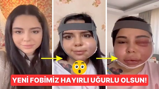 Estetik Ameliyatından Sonra Yüzü Gözü Fena Şişen Kadın Süreci Aşama Aşama Gösterdi, Görenler Şok Oldu!