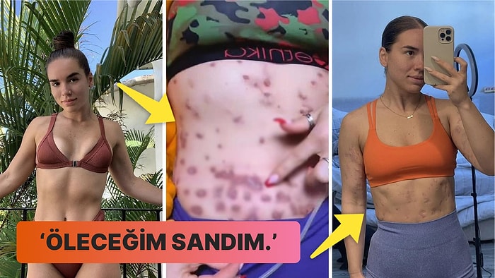 Yağ Yakan İğnelerden Sonra Derisi İflas Etmeye Başlayan Influencer'ın Kan Donduran Hikayesi