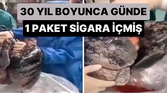 30 Yıl Boyunca Günde Yaklaşık 1 Paket Sigara İçen 52 Yaşındaki Adamın Akciğerlerinin Hali Viral Oldu