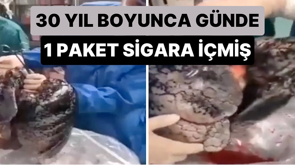 30 Yıl Boyunca Günde Yaklaşık 1 Paket Sigara İçen 52 Yaşındaki Adamın Akciğerlerinin Hali Viral Oldu