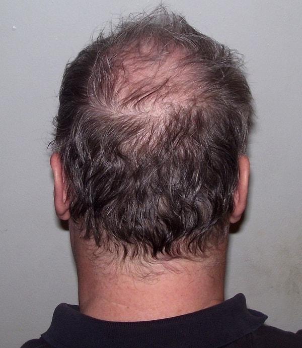 Androgenetik alopesi, erkeklerde başın üst ve ön kısmında saç dökülmesine, kadınlarda ise genel olarak incelmeye neden olur.