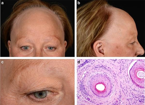 Alın ve favoriler gibi kafa derisinin ön bölgesini etkileyen bir tür yara izli saç dökülmesi olan frontal fibrozan alopesi, çoğunlukla menopoz sonrası kadınları etkiler, ancak erkekleri ve genç kadınları da etkileyebilir.