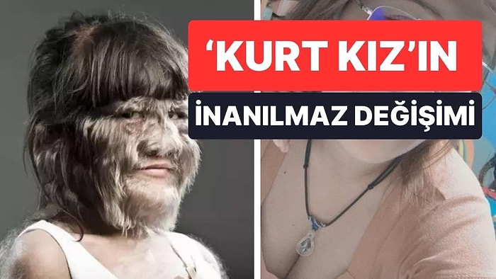 'Kurt Kız' Büyüdü! 'Dünyanın En Tüylü Kızı'nın Son Hali Görenleri Şaşkına Çevirdi!