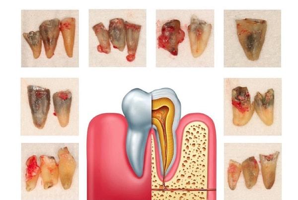 Bazı kadınlar memede oluşan hastalıkların diş ile de bağlantılı olduğunu iddia ediyor.
