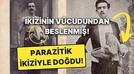 Yıllarca Aynı Vücudu Paylaştılar: Parazit İkizle Dünyaya Gelen Adamın Tüyler Ürperten Hikayesi