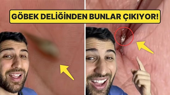 Göbek Deliğinin Tam Temizlenmediğinde Neler Olacağını Söyleyen Doktor Herkesin Midesini Ağzına Getirdi