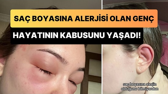 Saç Boyasına Alerjisi Olduğunu Bilmeyen Gencin Hayatı Kabusa Döndü!