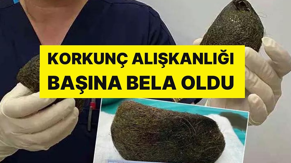 Karın Ağrısıyla Gitti, Midesinden Çıkanlar Herkesi Şoke Etti: 2 Kilo Saç Çıktı