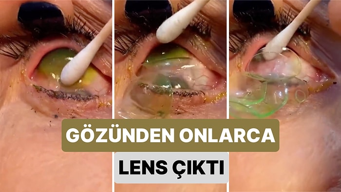 Üst Üste Onlarca Lens Takan Kadının Gözlerinin Temizlendiği Anı İzlerken Başınıza Ağrılar Girecek