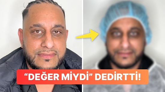 Göz Rengini Değiştirmek İçin Bıçak Altına Yatan Adam İçinizi Bi' Tuhaf Yapacak