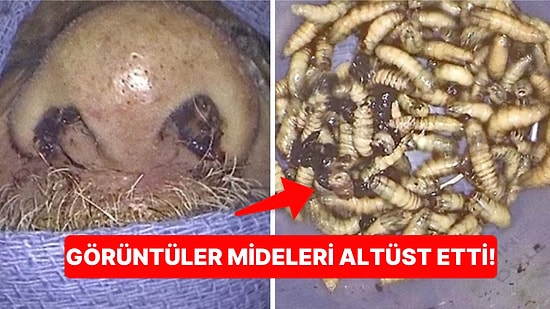 Halsizlikten Dolayı Hastaneye Giden Adamın Burnundan 150 Tane Kurtçuk Çıktı!