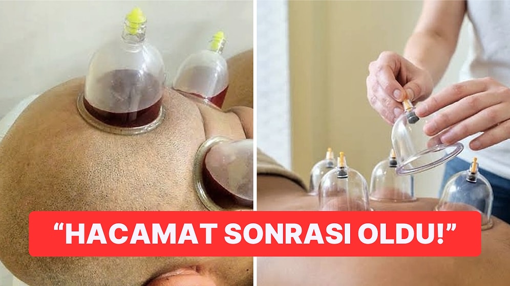 "Hacamat Ruhani Bir Ayindir" Diyen Doktor Hastasının Yakalandığı Ölümcül Hastalığı Anlattı!