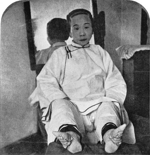 4. Çocukluğundan beri ayakları bağlı olan Çinli bir kadın. Çin'de kücük ayak bir güzellik standartı olduğu için kadınlar ayaklarını yıllar boyu bağlı tutardı. (1800'ler)