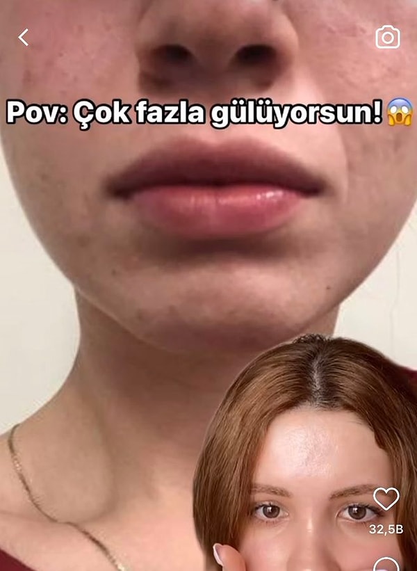 Geçtiğimiz günlerde bir kullanıcı 'Çok fazla gülümsüyorsun!' notuyla paylaştığı videoda gülmenin kazayağı ve gözaltı kırışıklıklarına sebep olabileceğinin altını çizdi.