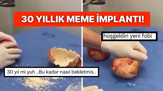 30 Yıllık Bir Meme İmplantındaki Kireçlenmeyi Gösteren Doktor Yeni Fobi Kilitlerini Açtı