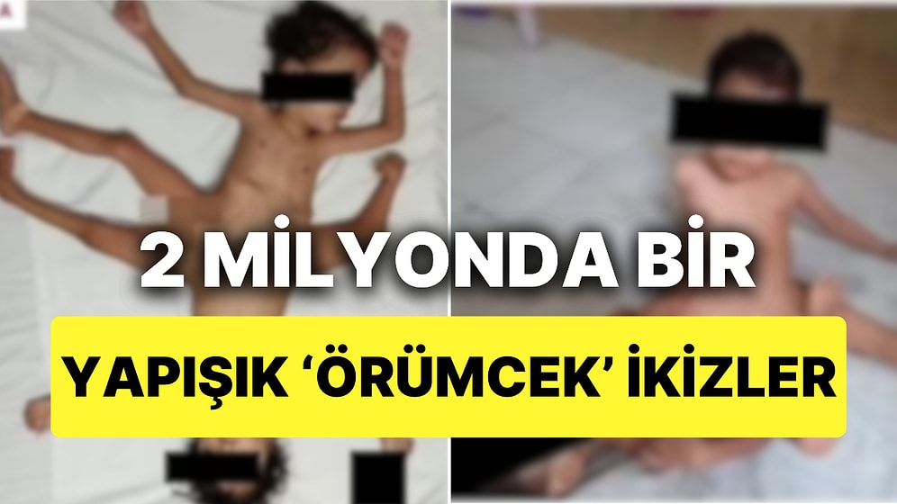 Üç Bacakları, Dört Kolları ve Bir Penisleri Var: Pelvis Bölgesinden Yapışık İkizler