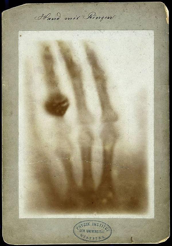 15. Çekilen ilk röntgen.