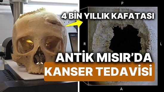 Antik Mısır'da Beyin Kanseri Tedavisi! 4 Bin Yıllık Kafatası En Eski Kanser Ameliyatının İpuçlarını Saklıyor!