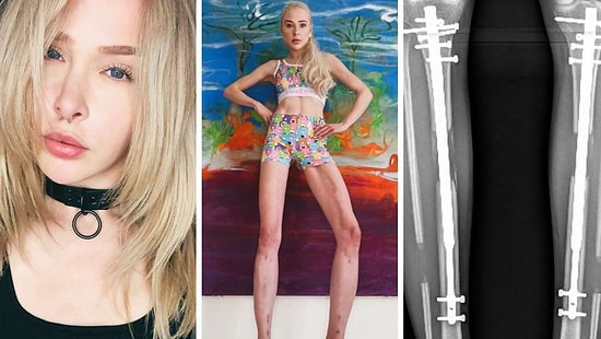 Reality Star Spends $160K to Lengthen Legs, Now Battles Bone Diseases
