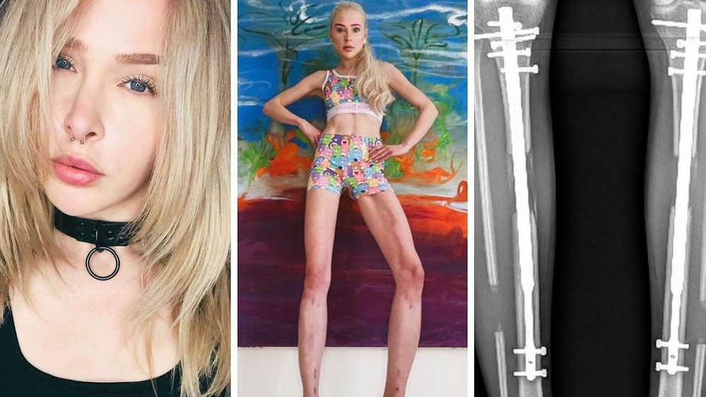 Reality Star Spends $160K to Lengthen Legs, Now Battles Bone Diseases