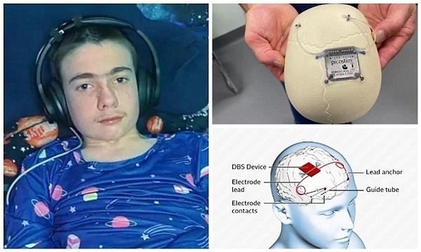 Following the surgery, Oran's device was activated to provide continuous mild electrical stimulation aimed at blocking pathways that trigger seizures in his brain.