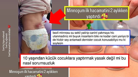 2 Aylık Bebeğe Hacamat Yaptıran Ailenin Bilinçsizliği Sosyal Medyada İnfial Yarattı