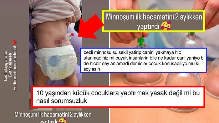 2 Aylık Bebeğe Hacamat Yaptıran Ailenin Bilinçsizliği Sosyal Medyada İnfial Yarattı