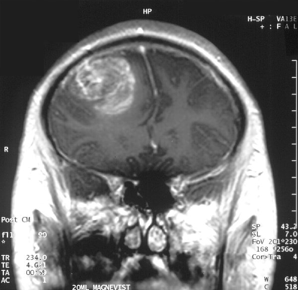 Peki, Glioblastoma (GBM) Nedir?