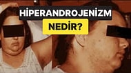 Birçok Hastalığa Davetiye Çıkaran Hiperandrojenizm Nedir, Nasıl Tedavi Edilir, Neden Olur?