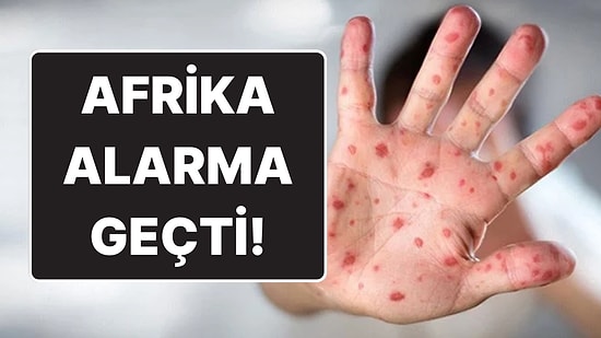 Afrika’da Hızla Yayılıyor: Maymun Çiçeği Salgını İçin Acil Durum İlan Edildi