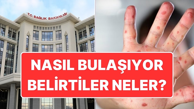 Sağlık Bakanlığı’ndan Maymun Çiçeği Rehberi: Virüs Nasıl Bulaşıyor, Belirtileri Neler?