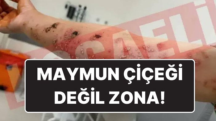 Kocaeli’nde Maymun Çiçeği Vakası Tespit Edildi İddiası: Hastalık Zona Çıktı!