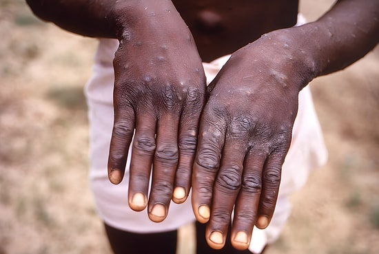 Should We Be Worried About Monkeypox? WHO Declares Global Emergency