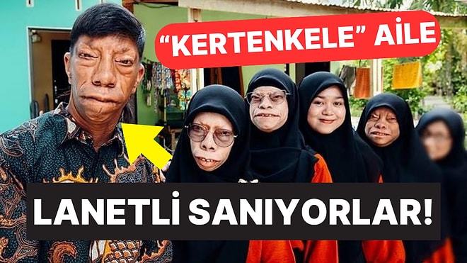 Lanetli Sanıyorlar! 'Kertenkele Surat' Lakabına Sahip Maurung Ailesinin Trajik Hikayesi