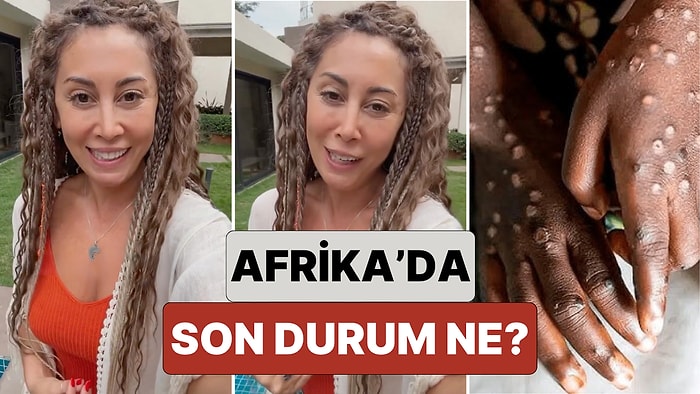 Kenya'da Yaşayan Bir Türk Afrika'da Maymun Çiçeği ile İlgili Gelişmeleri ve Son Durumu Anlattı